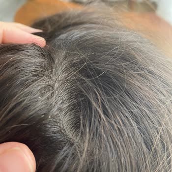 Egzamalı Cilt İçin Uygun Olmayan Ürünler