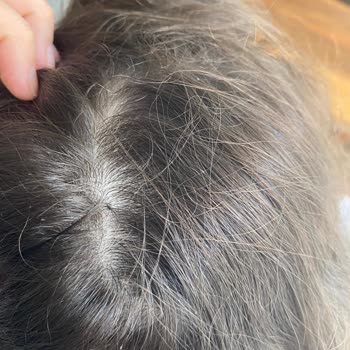 Egzamalı Cilt İçin Uygun Olmayan Ürünler