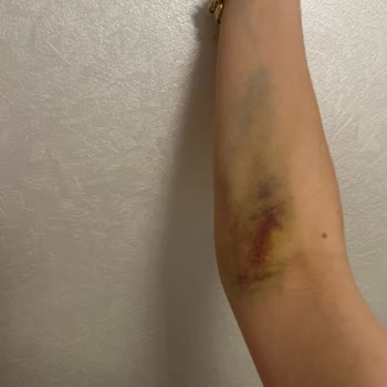 Acil Serviste Hemşire Hatası İle Yaşanan Ağrılı Deneyim