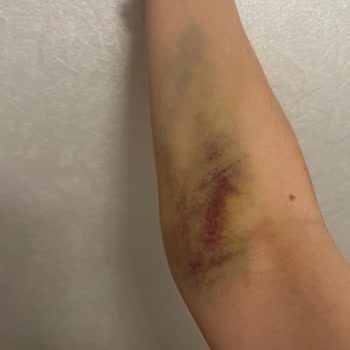 Acil Serviste Hemşire Hatası İle Yaşanan Ağrılı Deneyim