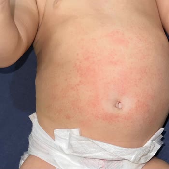 Bioderma Atoderm Kullanımı Sonrası Cilt Reaksiyonu