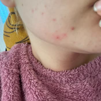 Cilt Ürünü Sivilce Sorunu Yarattı