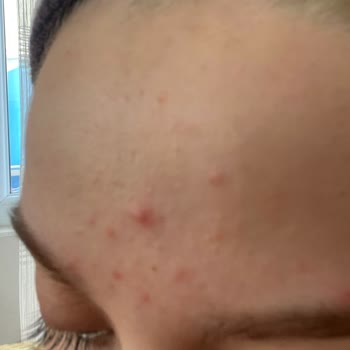 Cilt Ürünü Sivilce Sorunu Yarattı