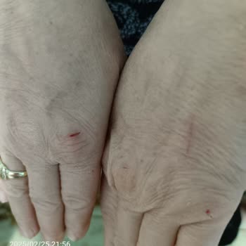 Nivea Soft Krem Alerjik Reaksiyon Yarattı