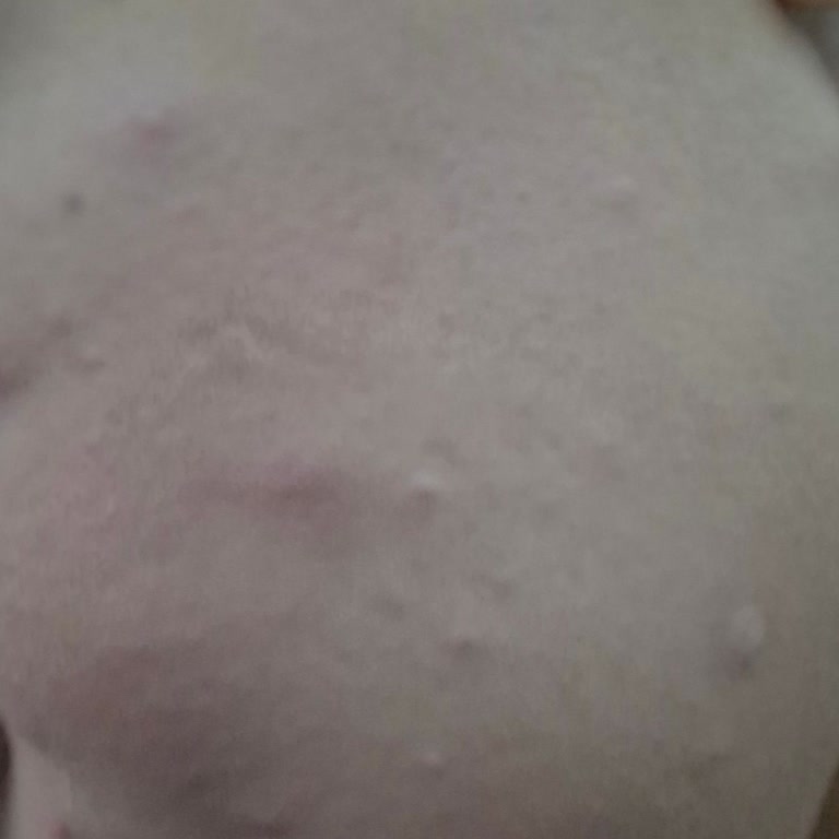 Maybelline Fondöten Cilt Sorunu Yarattı