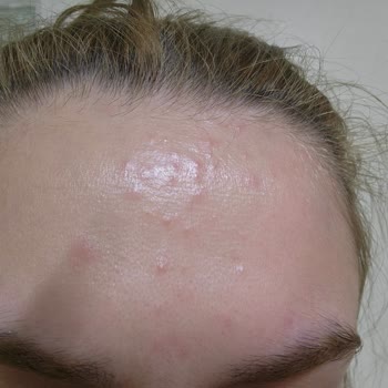 Wiwify Ürünleriyle 1 Gecede Gelen Sivilce Şoku