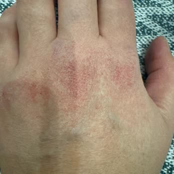 Mutfak Temizleyici Ellerimi Yara Yaptı!