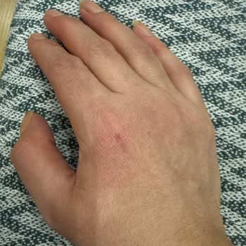 Mutfak Temizleyici Ellerimi Yara Yaptı!