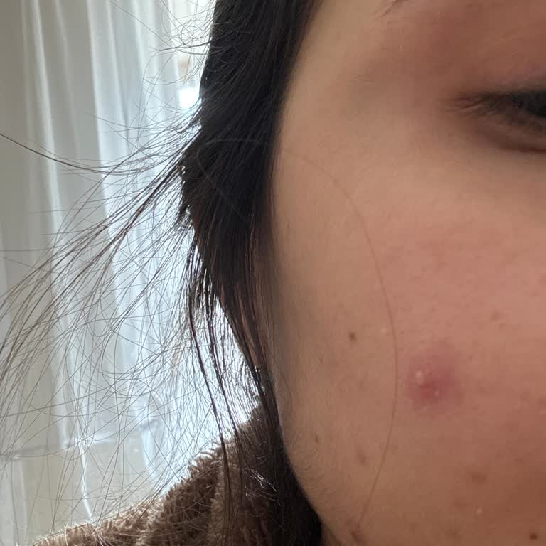 Övülen Marka Yüzümü Mahvetti