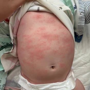 Bebeğimde Mustela Krem Sonrası Kırmızı Döküntüler Oluştu