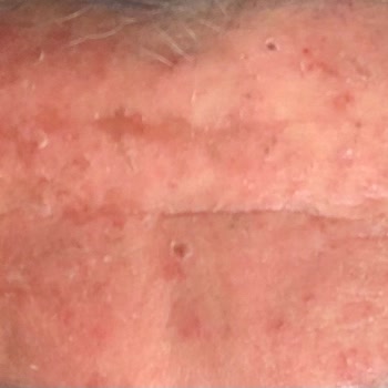 Ciltte Alerjik Reaksiyon Ve Kaşıntıya Neden Olan Boya