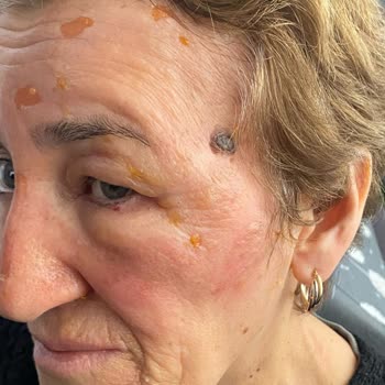 Emsan Mutfak Düdüklü Tencere Patlaması ve Yanık Tehlikesi