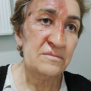 Emsan Mutfak Düdüklü Tencere Patlaması ve Yanık Tehlikesi