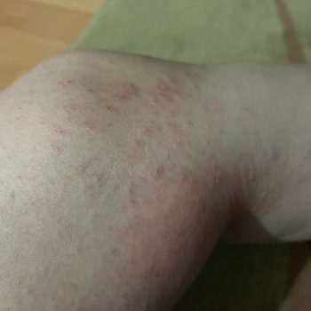 Veet Krem Kullanımı Sonrası Ciddi Yanık Problemi