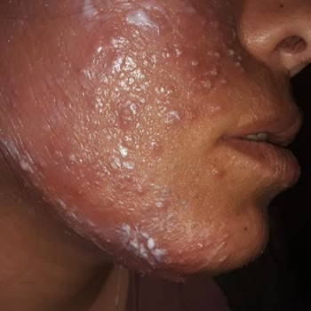 Yanlış Tedavi Sonucu Yüzümde Kalıcı Hasar Oluştu