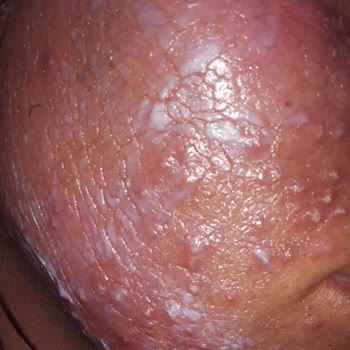 Yanlış Tedavi Sonucu Yüzümde Kalıcı Hasar Oluştu