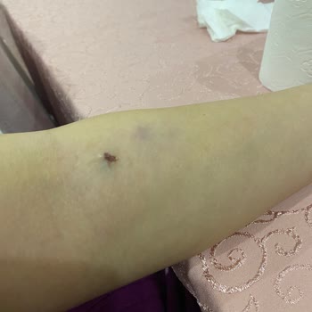 Hastanede Damar Yolu Açma Sorunu Ve İlgisizlik