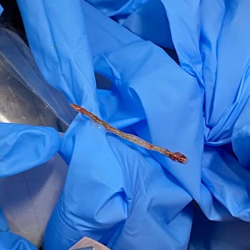 Tavuk Dönerdeki Yabancı Cisim Oğlumun Boğazına Takıldı, Hastaneye Gittik