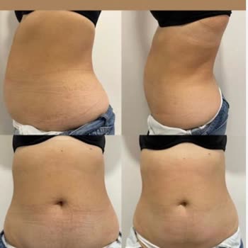 Yanıltıcı Zayıflama Vaatleri Ve Para İadesi Sorunu