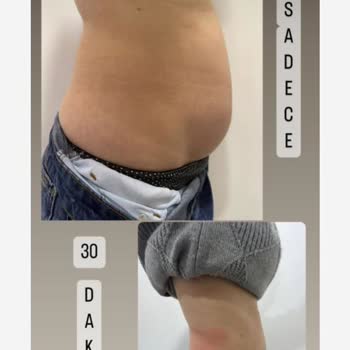 Yanıltıcı Zayıflama Vaatleri Ve Para İadesi Sorunu