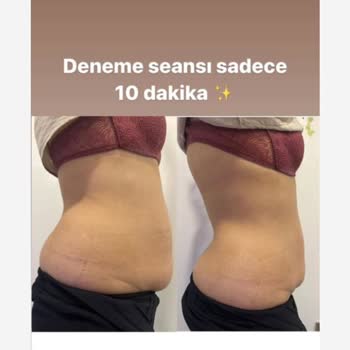 Yanıltıcı Zayıflama Vaatleri Ve Para İadesi Sorunu