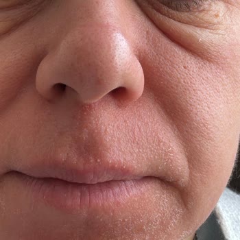 C Vitamini Serumu İle Yaşanan Alerjik Reaksiyon