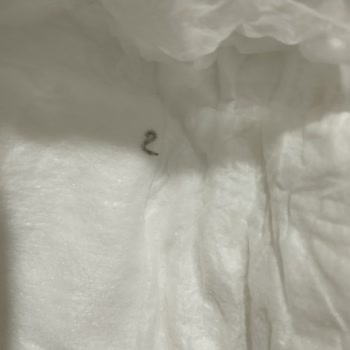 Bebek Bezi İçerisinde Tanımlanamayan Cisimler