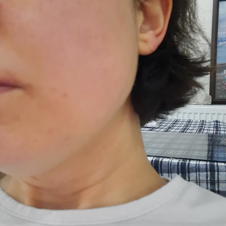 Yves Rocher Ürünü İlk Kullanımda Ciltte Kızarıklık Yaptı!