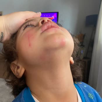 Ümraniye Hastanesi'nde Yetersiz Alerji Muayenesi