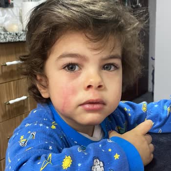 Ümraniye Hastanesi'nde Yetersiz Alerji Muayenesi