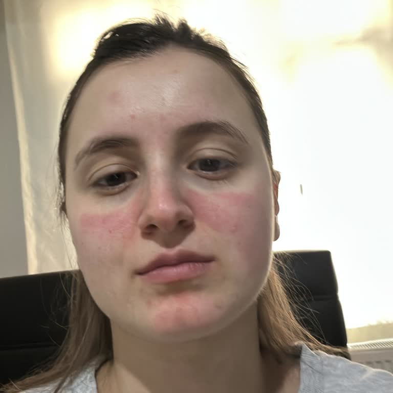 Ciltte Yanma Ve Kızarıklık Yapan Krem