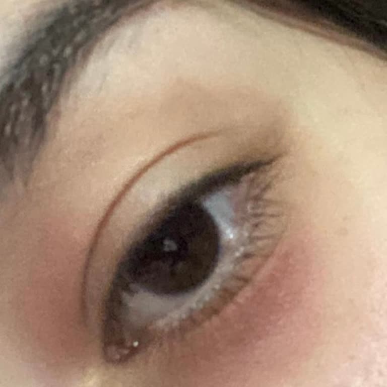 Loreal Paris, suero para ojos causa alergia y eczema