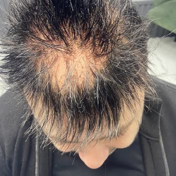 B&B Protez Saç Merkezi Saç Ekimi Sonrası Hayal Kırıklığı Ve Sorunlar