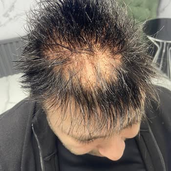 B&B Protez Saç Merkezi Saç Ekimi Sonrası Hayal Kırıklığı Ve Sorunlar