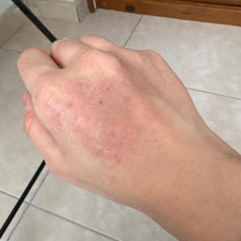 Activex Sıvı Sabun Kullanımı Sonrası Egzama Ve Cilt Sorunları