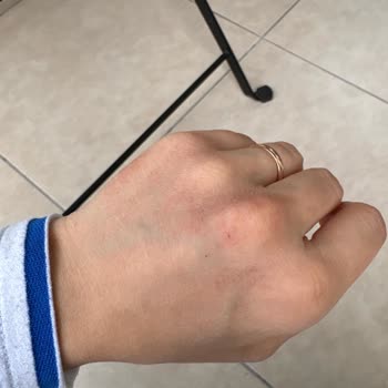 Activex Sıvı Sabun Kullanımı Sonrası Egzama Ve Cilt Sorunları