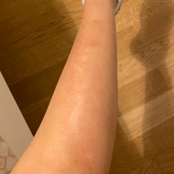 Ezgi Doğan Polikliniği Lazer Yanıkları Ve İade Talebinde Karşılaşılan Zorluklar!