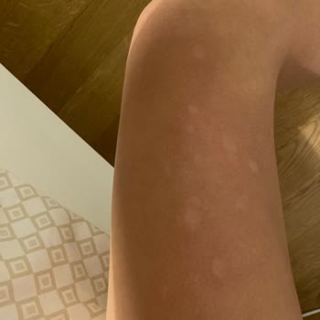 Ezgi Doğan Polikliniği Lazer Yanıkları Ve İade Talebinde Karşılaşılan Zorluklar!