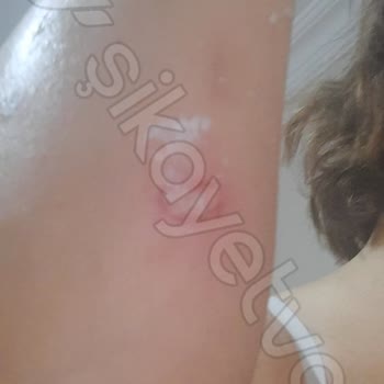 Lazer Epilasyon Sonrası Yanık Şoku