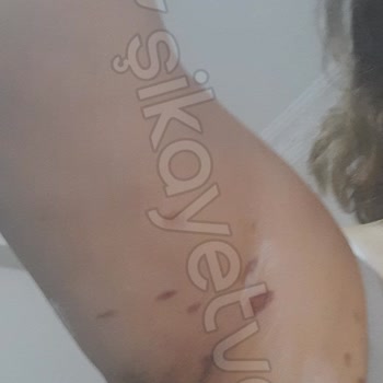 Lazer Epilasyon Sonrası Yanık Şoku