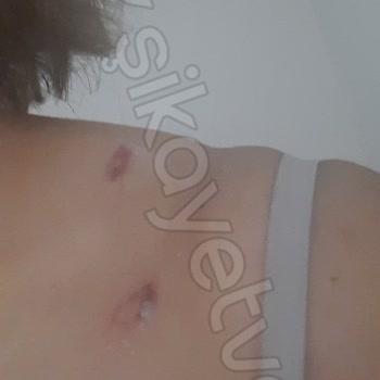 Lazer Epilasyon Sonrası Yanık Şoku