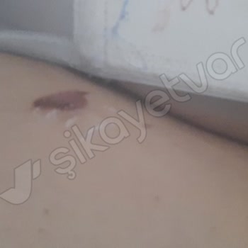 Lazer Epilasyon Sonrası Yanık Şoku