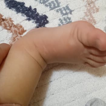 Probiyotik Kullanımı Sonrası Bebeğimde Korkutucu Alerjik Reaksiyon