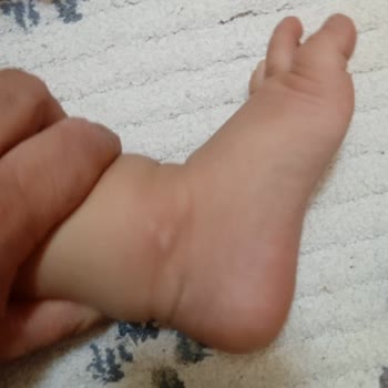 Probiyotik Kullanımı Sonrası Bebeğimde Korkutucu Alerjik Reaksiyon