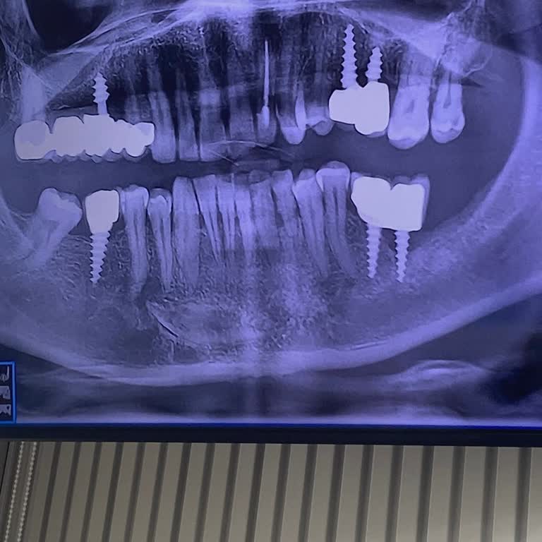 Akdent Ağız Ve Diş Sağlığı Merkezi 2 İmplantım Sallandı