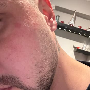 Üçlü Maske Kullanımı Sonrası Cilt Sorunları