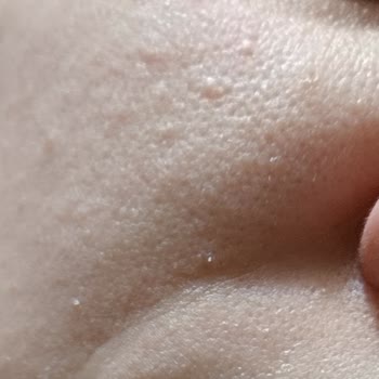 Su Bazlı Krem Yüzde Tahrişe Neden Oldu