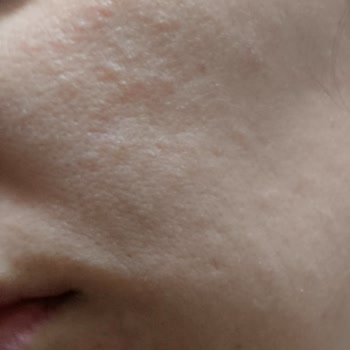 Su Bazlı Krem Yüzde Tahrişe Neden Oldu