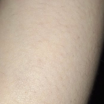 Nureste Estetik Lazer Epilasyon Hizmetinde Memnuniyetsizlik Ve Randevu Sorunları