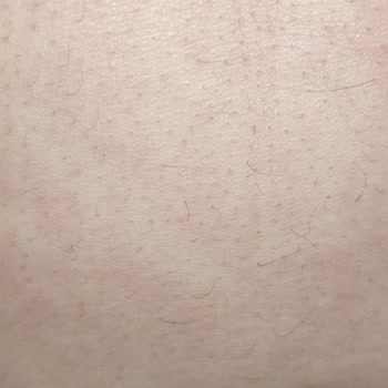 Nureste Estetik Lazer Epilasyon Hizmetinde Memnuniyetsizlik Ve Randevu Sorunları